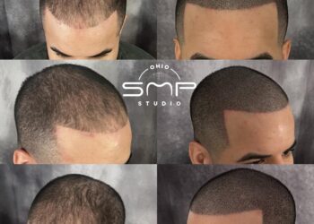 Scalp Micropigmentation: Newark’s Go-To Solution for Hair Loss
