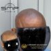 Breaking the Stigma: How Scalp Micropigmentation Empowers Individuals