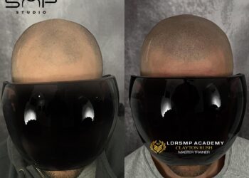 Scalp Micropigmentation: A New Era of Hair Restoration