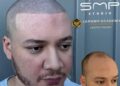 Redefining Confidence with Scalp Micropigmentation