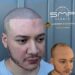 Redefining Confidence with Scalp Micropigmentation